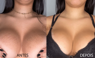 antes e depois 03 1
