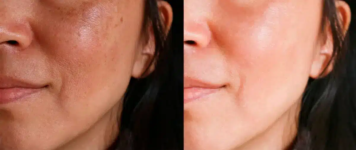 ROSA AMAZÔNICA SERUM 3 manchas piel 1 1