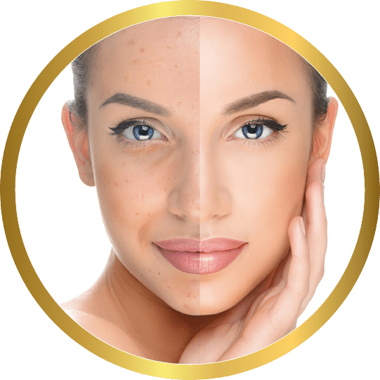 Home 14 Melasma