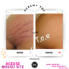 Creme Vegano p/ Estrias - TOE | 3 uni 2 AntesDepoisCremeTOE 24