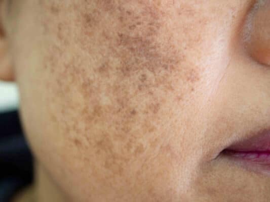 Melasma: Causas, Tratamentos e Prevenção