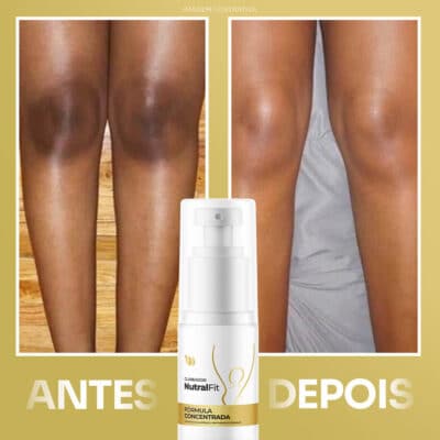 creme clareador para melasma DEP1 1