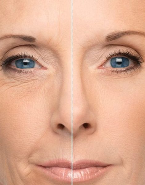 acido-hialuronico-facial-antes-y-despues