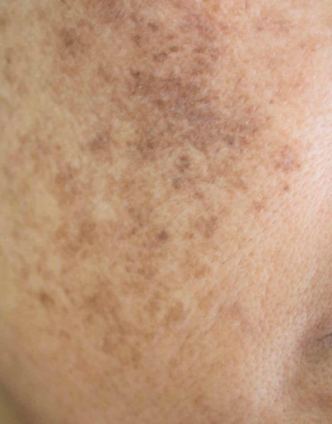 Melasma: Causas, Tratamentos e Prevenção