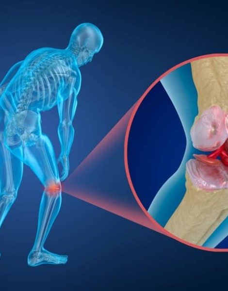 osteoporose